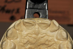 Figure 6    Incisal view of anteriors showing the lingual positioning of teeth Nos. 8 and 9 and heavy wear facets.