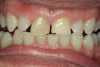 Figure 22 and Figure 23 The parameters for determining incisal edge position should be repeated after completion of the provisional restorations. These provisionals were evaluated for contour and interaction with the lips at rest. The functional position of the teeth must be evaluated by the patient during this phase. This information can then be transferred to the technician.