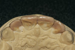 Figure 8   Diagnostic wax-up bringing teeth Nos. 8 and 9 facially and tucking teeth Nos. 7 and 10 back into arch form. The functional path was preserved all the way to the incisal edge.