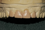 Figure 9: Facial view of the wax-up.