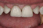 Figure 13  Roughed out restorations teeth Nos. 8 and 9 with initial contouring completed.