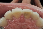 Figure 14  Incisal view showing improved edge position, developed from the wax-up.