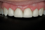 Figure 15  Note the ability to close diastemas while keeping a harmonious tooth form.