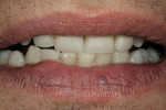 Figure 16  Edge-to-edge position at the 1-week postoperative check. Value, hue, and chroma blend well with the patient’s natural dentition.