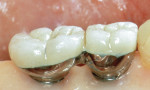 Surgical placement and restoration using a conventional surgical guide. Lingual view of final restorations.