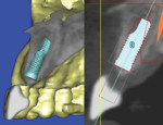 Surgical implant placement using a virtual plan and computer-generated surgical guide. Virtual plan. Figure 8 was previously published in Clin Adv Periodontics 2012;2:263-273 and reproduced with permission from the
American Academy of Periodontology.