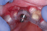 Surgical implant placement using a virtual plan and computer-generated surgical guide. Figure 13 was previously published in Clin Adv Periodontics 2012;2:263-273 and reproduced with permission from the
American Academy of Periodontology.