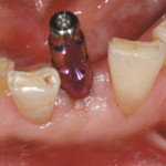 Implants and restorations placed in unfavorable positions. Implant with impression post in place.