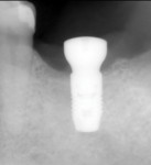 Dental student case utilizing virtual planning and a computer-generated stereolithographic guide. Postoperative periapical radiograph.tw