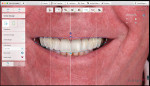 Digital Smile design.