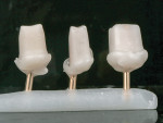 Copy abutments for implant crowns.
