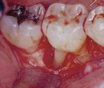 Figure 6  Lesion wraps around to the facial aspect of the molar.