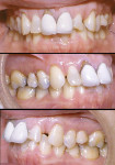 Figure 9  Pretreatment intraoral views. Note the deep overbite, large overjet, andcomplete buccal version of tooth No. 13.
