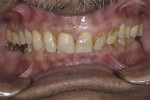 Fig 2. Pretreatment smile (Fig 1); pretreatment intraoral view of teeth in occlusion (Fig 2); pretreatment intraoral view depicting wear pattern of teeth (Fig 3).