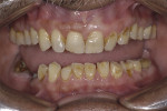 Fig 3. Pretreatment smile (Fig 1); pretreatment intraoral view of teeth in occlusion (Fig 2); pretreatment intraoral view depicting wear pattern of teeth (Fig 3).