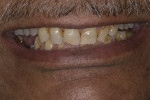 Fig 1. Pretreatment smile (Fig 1); pretreatment intraoral view of teeth in occlusion (Fig 2); pretreatment intraoral view depicting wear pattern of teeth (Fig 3).