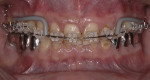 Fig 4. Orthodontic phase of treatment.