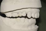 Fig 6. Discrepancy was apparent in anterior and posterior occlusal plane after orthodontics.