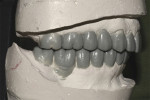 Fig 8. Wax-up at increased VDO (Fig 7) and eliminating the discrepancy in the occlusal plane (Fig 8).
