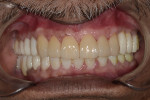 Fig 14. Bonded lithium-disilicate restorations on maxillary anterior teeth.