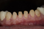 Fig 15. Conservative tooth preparations for mandibular anterior teeth.