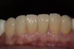 Fig 16. Bonded lithium-disilicate restorations on mandibular anterior teeth.