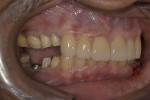 Fig 17. Anterior definitive restorations served as a stop for maintaining vertical dimension when making posterior prosthesis impressions (right side is shown).