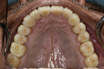 Fig 22. Uniform occlusal contacts in the definitive restorations; maxillary (Fig 22) and mandibular (Fig 23).