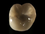 Figure 2  Zir-Max offers clinicians and patients beauty and strength in full-coverage molar and premolar restorations.