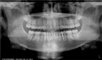 Fig 13. Four months post placement of MDIs for congenitally missing teeth Nos. 21 and 28 (Fig 11); post cementation of lithium-disilicate MISFRs for Nos. 21 and 28 (Fig 12); panoramic radiograph 4 months post placement (Fig 13).