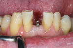 Fig 15. Preoperative photograph showing missing tooth No. 25 (Fig 14); post placement of MDI at No. 25 (Fig 15).