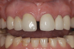 Fig 2. Severe attrition was evident on the mandibular anterior teeth.