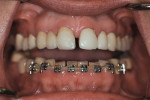 Fig 5. Orthodontic intrusion completed, reducing the risk for attrition on the lower anterior teeth.