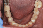 Fig 3. Preoperative occlusal view of mandibular dentition, showing worn anterior teeth and fractured porcelain crowns.