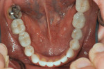 Fig 9. Postoperative occlusal view of mandibular dentition, which can be compared to the preoperative condition shown in Fig 3.