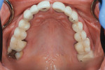 Fig 7. Preoperative occlusal view of maxillary dentition.