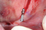 Figure 5  The implant was inserted into the pilot opening.