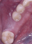 Fig 1. Occlusal view at presentation showing the edentulous area of tooth No. 19. Note the significant buccal defect.