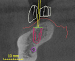 Fig 3. Cross-sectional view showing proposed implant placement and final restoration.
