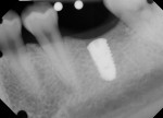 Fig 9. Final periapical x-ray showing ideal implant placement.