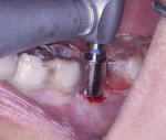 Fig 7. Final implant drill. Note that the surgical guide controls the position of the drill.
