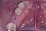 Fig 10. Gingival tissues at 2-week postoperative appointment.