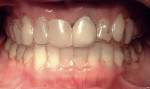 Figure 10b  Aligner with tooth No. 8 filled with composite.