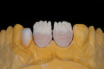 Fig 3. Opacious dentin mixed with 10% VITA INTERNO® 01 (Vita North America; vitanorthamerica.com).