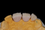 Fig 5. Note the thinness of the incisal edge.