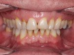 Fig 1. Preoperative retracted smile photograph.