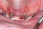 Figure 9: The four implants were inserted until no thread portions were visible. Photographs used with permission from Glidewell Laboratories.