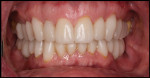 Fig 11. Seated temporary restorations were made for use for 8 to 10 weeks.