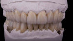 Fig 16. Completed final restorations are shown on model.