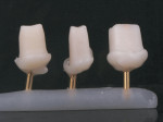 Fig 19. Copy abutments for implant crowns are made.